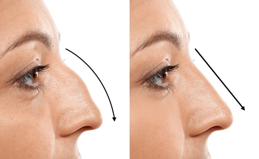 Most Common Kinds Of Rhinoplasty min